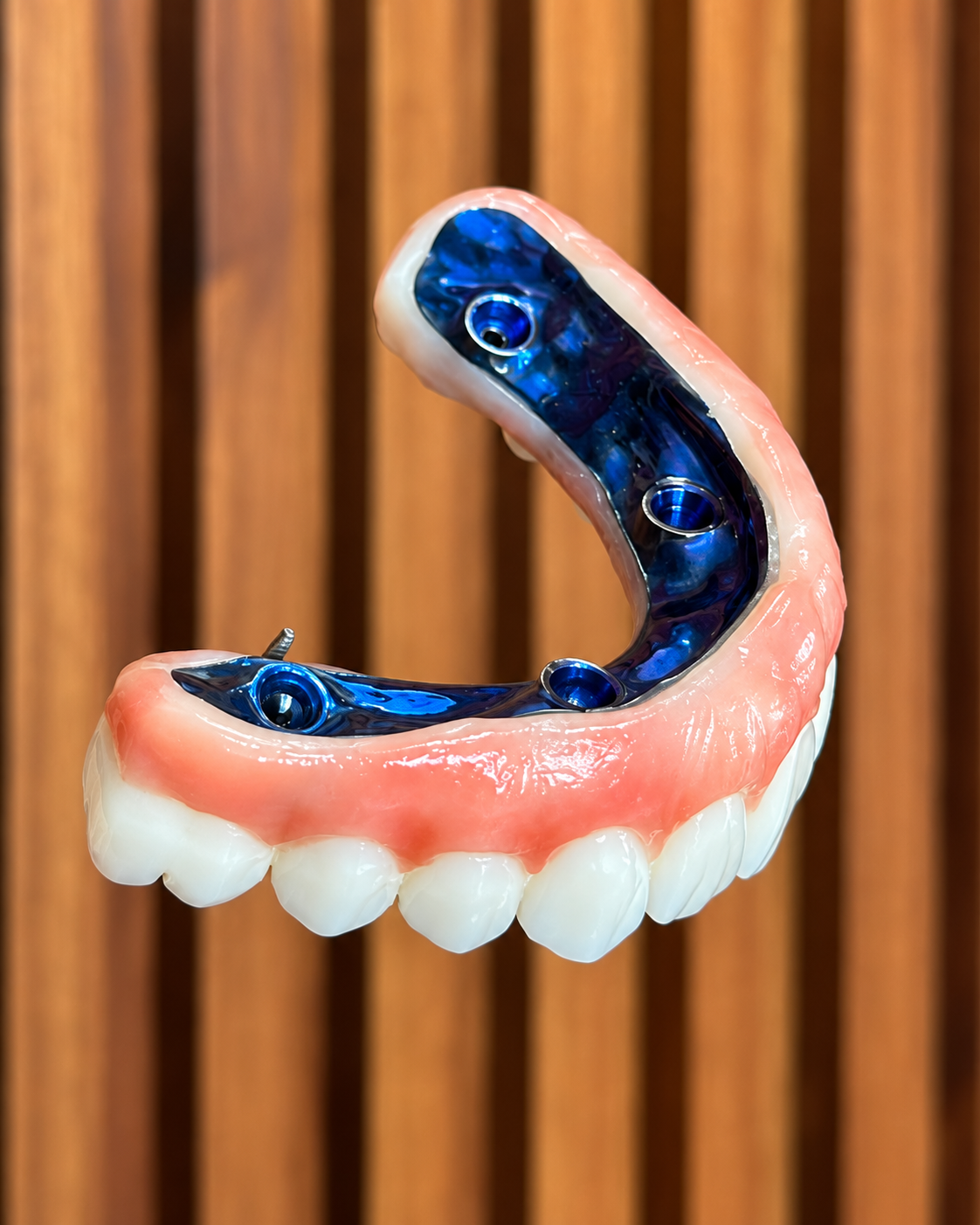 Prótesis sobre implantes dentales: vista de la base con los anclajes de titanio